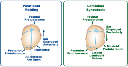 Positional plagiocephaly vs. lamboid synostosis.